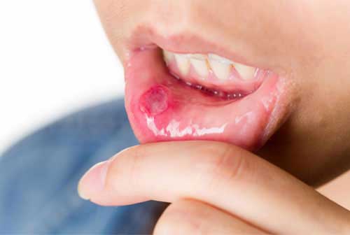 mouth-ulcer